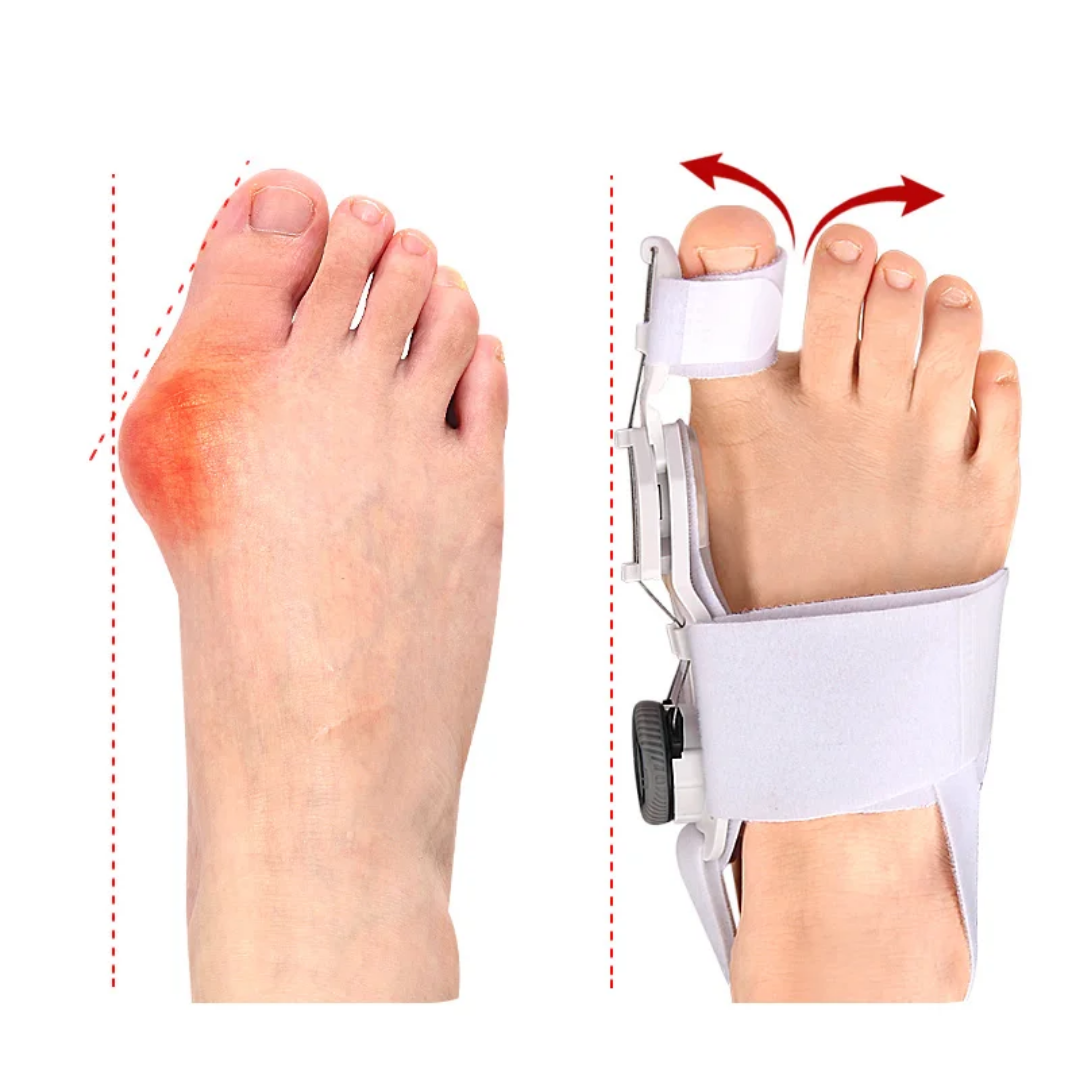 Adjustable Orthopedic Bunion Corrector – Hallux Valgus Toe Straightener